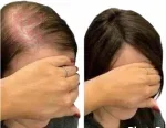 Garlic Collagen Ampoules 5 Ampoules for Hair Loss - Image 2